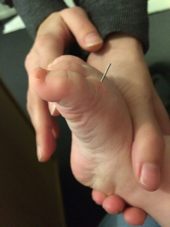 En akupunkturnål i en fod på et barn.